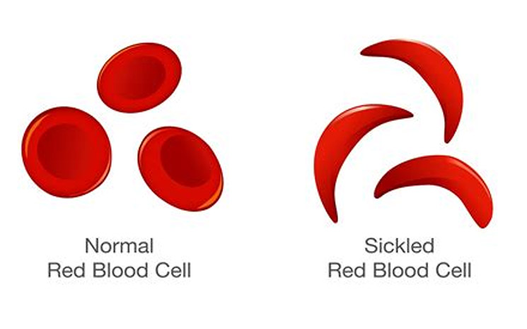 Photo of sickle cells vs normal red blood cells